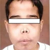 Tan máu bẩm sinh là gì? Nguyên nhân, dấu hiệu và cách điều trị hiệu quả