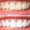 Tẩy trắng răng tiềm ẩn những tác hại không ngờ tới