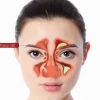Viêm xoang mũi là gì? Nguyên nhân, triệu chứng và cách phòng ngừa hiệu quả