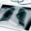X-ray là gì? Khám phá kỹ thuật chẩn đoán hình ảnh quan trọng