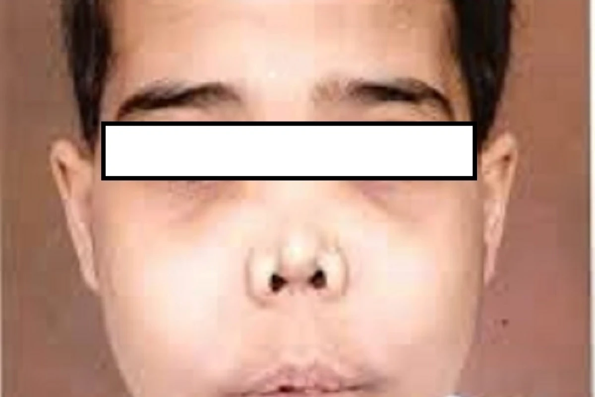 Tan máu bẩm sinh là gì? Nguyên nhân, dấu hiệu và cách điều trị hiệu quả