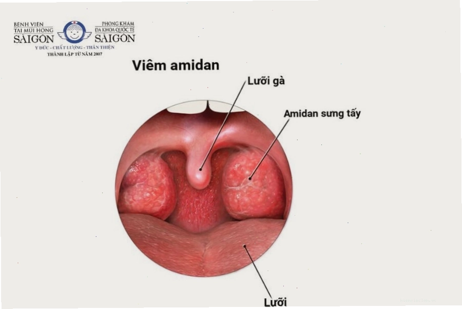 Amidan sưng to gây cảm giác vướng víu ở cổ họng