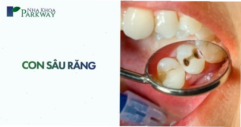 Bác sĩ đang kiểm tra tình trạng răng bị sâu của bệnh nhân