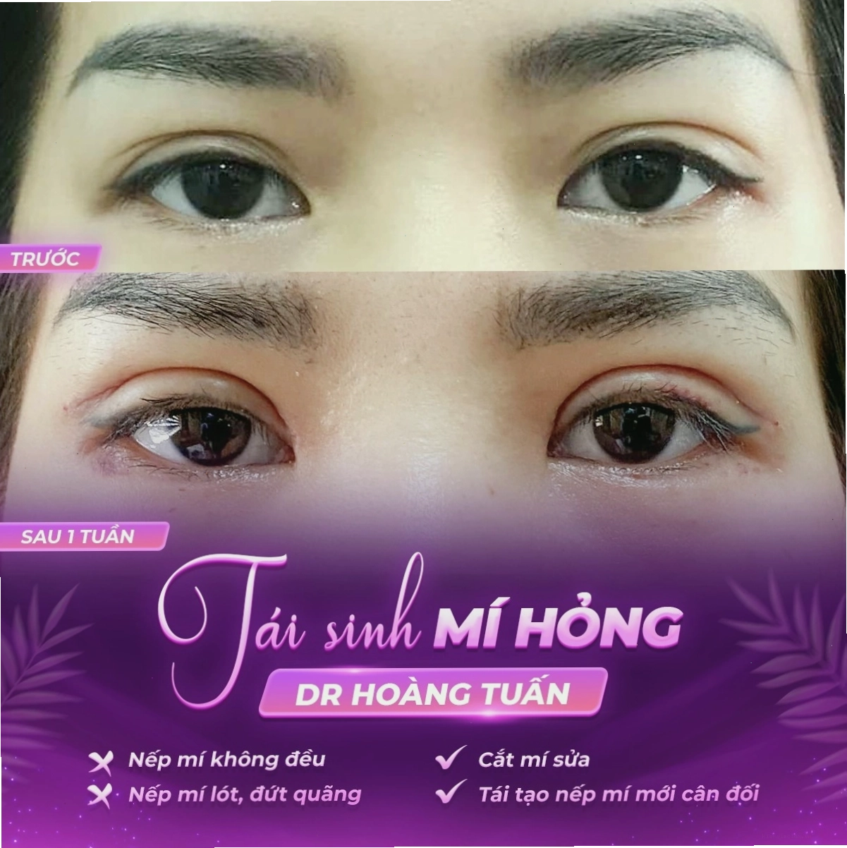 Bác sĩ tư vấn cho khách hàng trước khi cắt mí