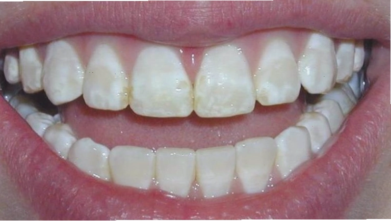 Baking soda có thể phá hủy men răng khi dùng không đúng cách