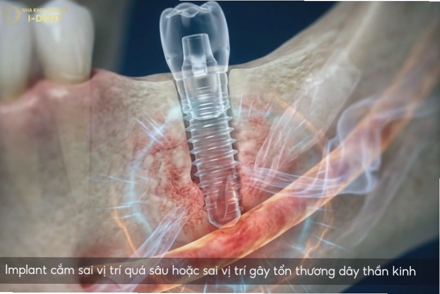 Biến chứng khi trồng răng implant có thể ảnh hưởng nghiêm trọng đến sức khỏe răng miệng