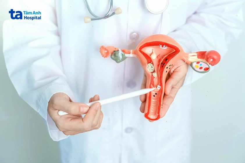 Các bệnh lý phụ khoa có thể là nguyên nhân gây đau bụng kinh thứ phát