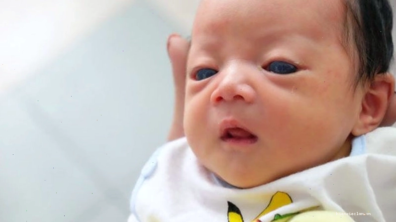 Các dấu hiệu mắt trẻ sơ sinh không bình thường không loại trừ do các bệnh lý về mắt