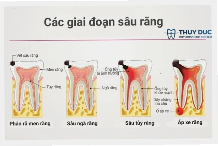Các giai đoạn phát triển của răng sâu