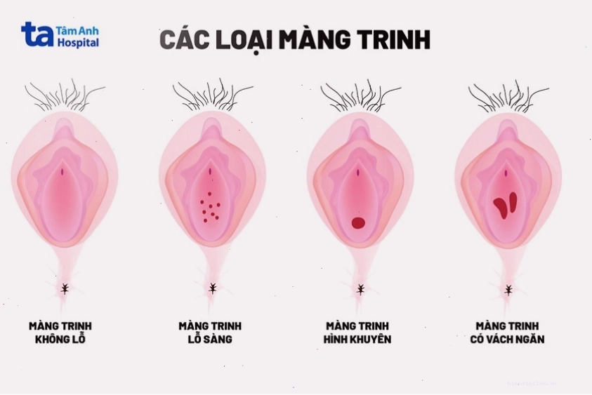 Các hình dạng của màng trinh