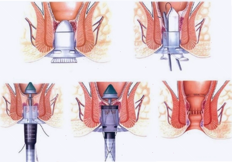 Các phương pháp điều trị bệnh trĩ