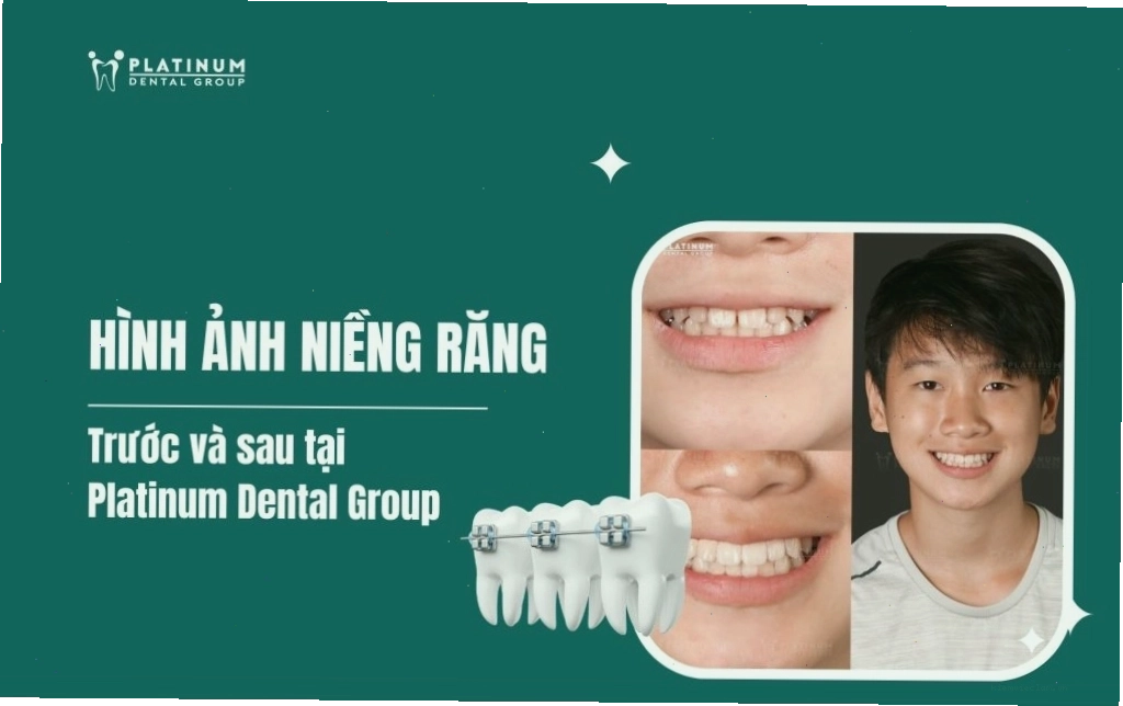 Các phương pháp điều trị răng lung lay chuyên sâu tại nha khoa