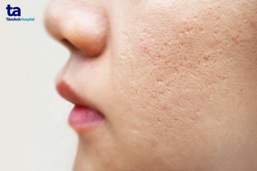 Các vị trí thường xuất hiện sẹo rỗ trên khuôn mặt