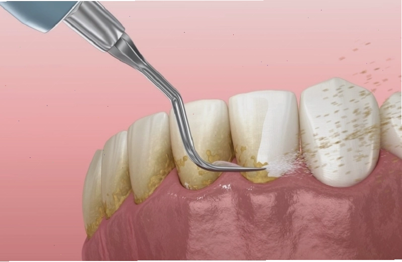 Cảm giác ê buốt răng sau khi lấy cao răng