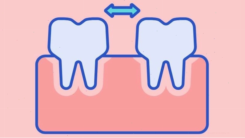 Cảm giác răng lung lay sau khi lấy cao răng