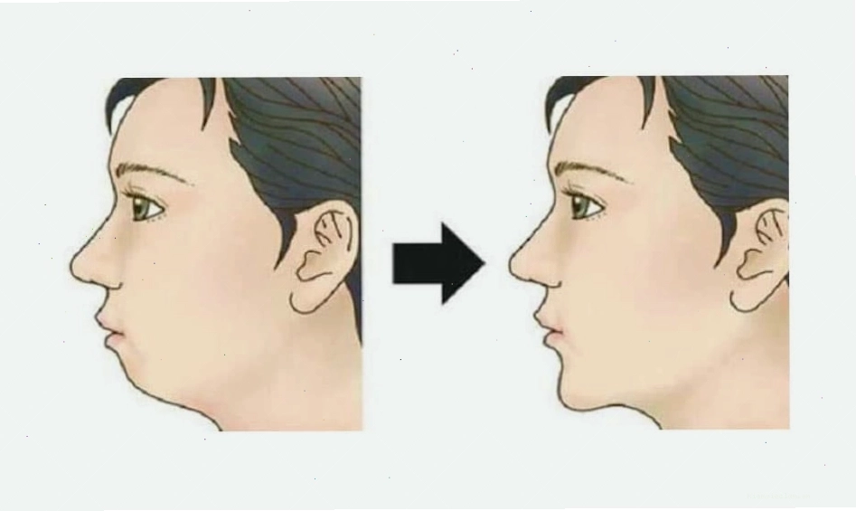 Cằm lẹm có thể gặp ở cả nam giới và nữ giới, ảnh hưởng thẩm mỹ khuôn mặt