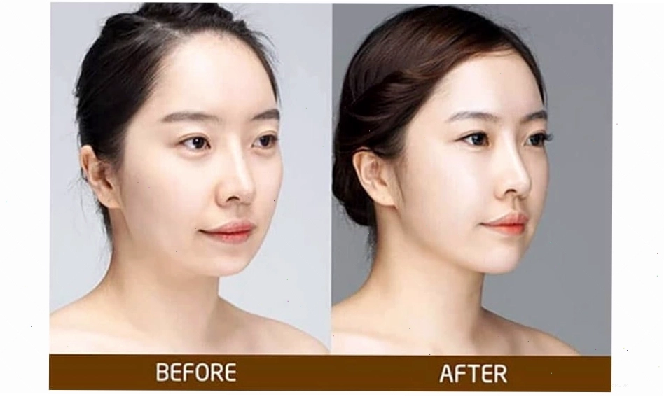 Cằm lẹm khiến tổng quan khuôn mặt giảm thanh tú