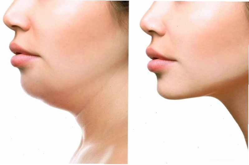 Cằm lẹm: Nguyên nhân, dấu hiệu nhận biết và cách khắc phục 4