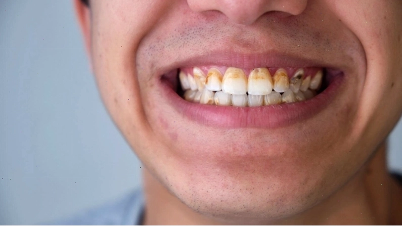 Cao răng tích tụ lâu ngày trên bề mặt răng gây mất thẩm mỹ