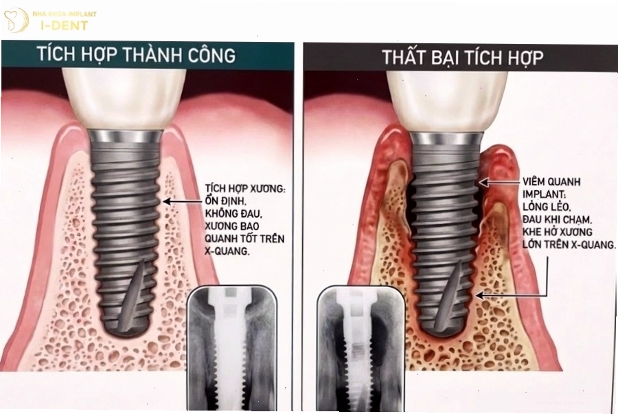 Cấy răng implant có ảnh hưởng gì không? Cần tìm hiểu kỹ trước khi quyết định
