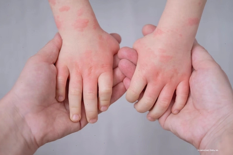 Có nhiều nguyên nhân gây nên tình trạng nổi mề đay ở trẻ