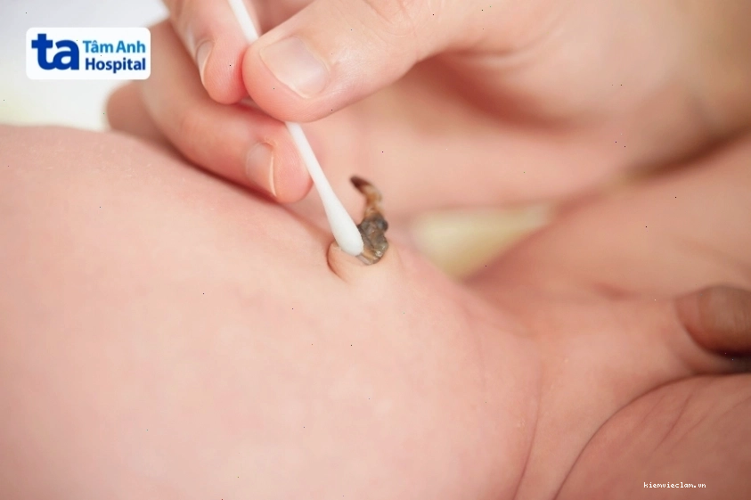 Cuống rốn trẻ sơ sinh sắp rụng, chuyển màu sẫm và khô lại