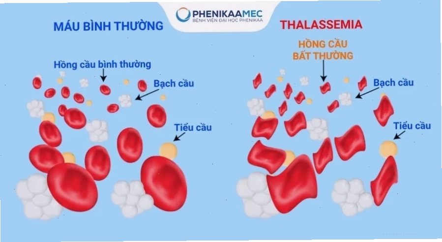 Dấu hiệu bệnh tan máu bẩm sinh ở người lớn