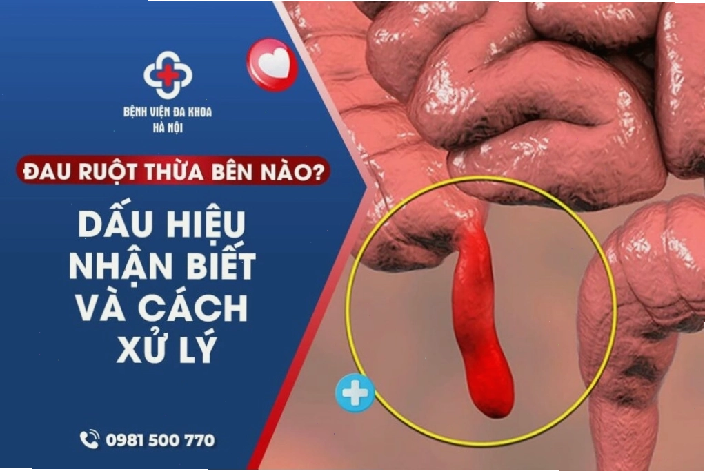 Dấu hiệu nhận biết đau ruột thừa và cách xử lý