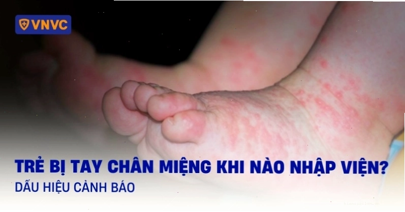 Dấu hiệu nhận biết khi trẻ bị bệnh chân tay miệng cần nhập viện