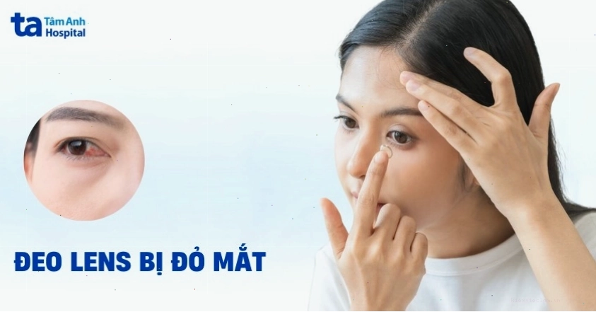 Đeo kính áp tròng Ortho-K sai cách có thể gây đỏ mắt và tổn thương bề mặt giác mạc