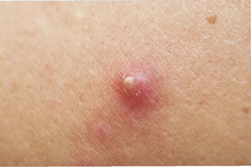 Đi khám bác sĩ khi mụn đầu đinh nghiêm trọng