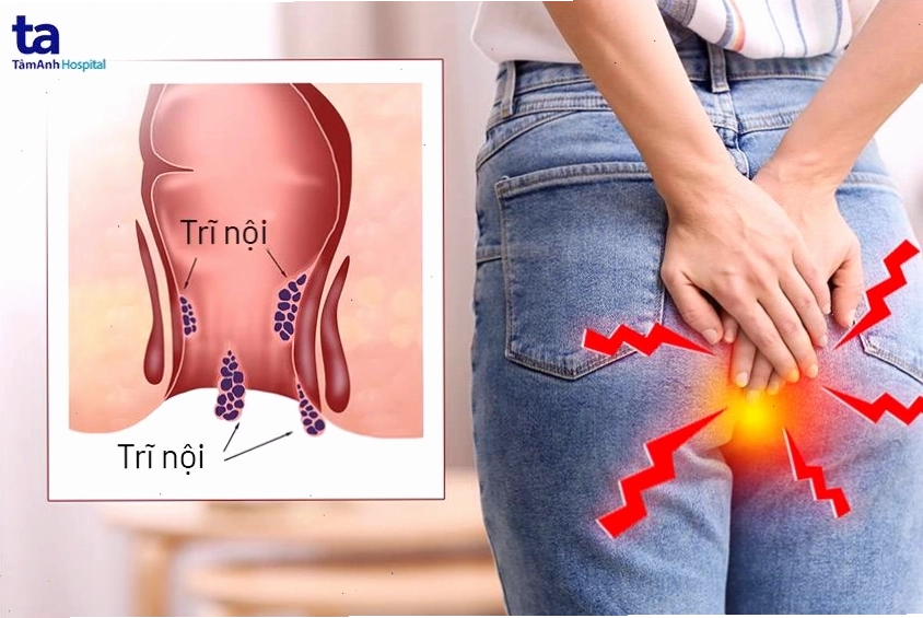 Đi ngoài ra máu tươi là dấu hiệu điển hình của bệnh trĩ nội