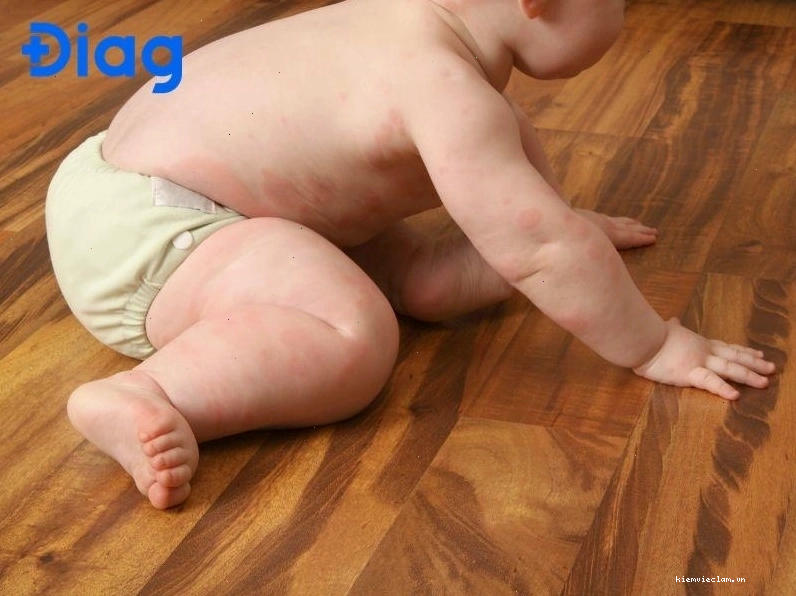 Dị ứng thời tiết là một trong những nguyên nhân gây dị ứng nổi mề đay ở trẻ.
