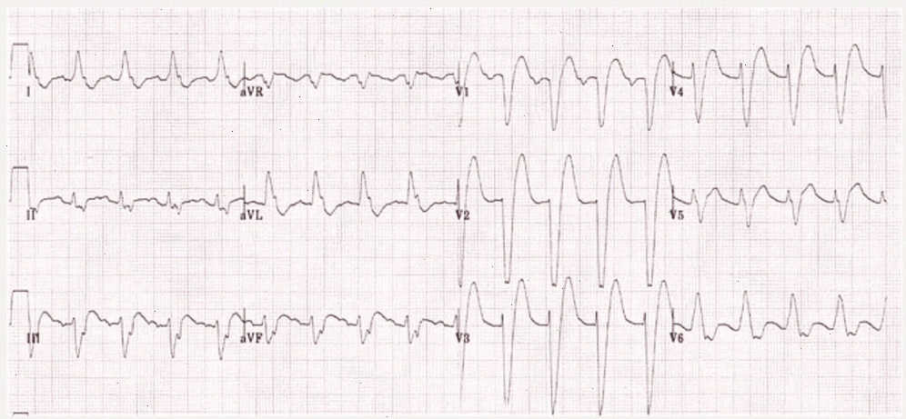 Điện tâm đồ biểu thị tình trạng QRS Block nhánh trái