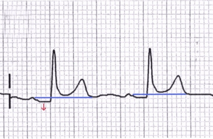 Đoạn PR hiển thị trên kết quả điện tâm đồ (ECG)