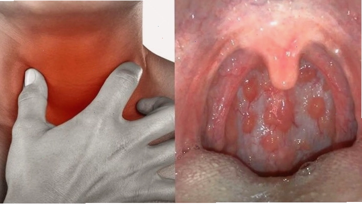 Giữ ấm cổ họng giúp phòng ngừa cảm giác vướng