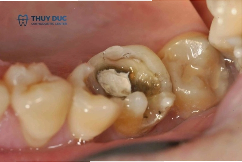 Hậu quả khi bị sâu răng nhưng không điều trị
