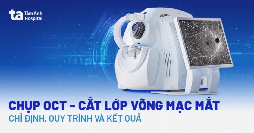 Hình ảnh cắt lớp võng mạc chi tiết từ phương pháp chụp OCT mắt