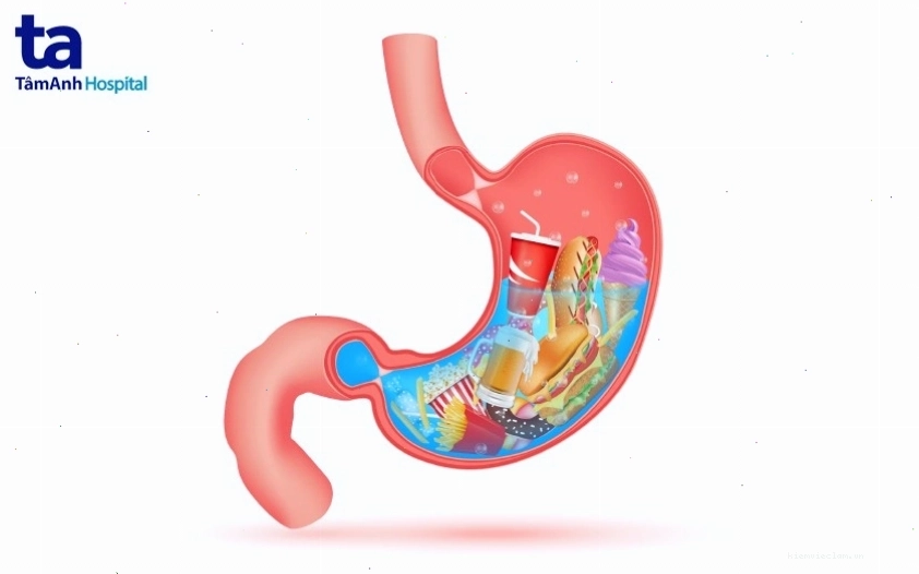 Hình ảnh minh họa các nguyên nhân phổ biến gây đau dạ dày