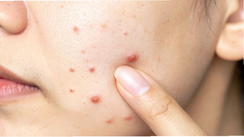 Hình ảnh minh họa cho những người có bệnh nền hoặc đang bị viêm da, mụn viêm không nên xăm chân mày