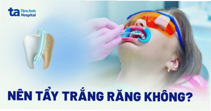 Hình ảnh minh họa người phụ nữ đang khám nha khoa để tư vấn về tẩy trắng răng
