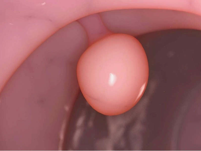 Hình ảnh minh họa polyp tử cung
