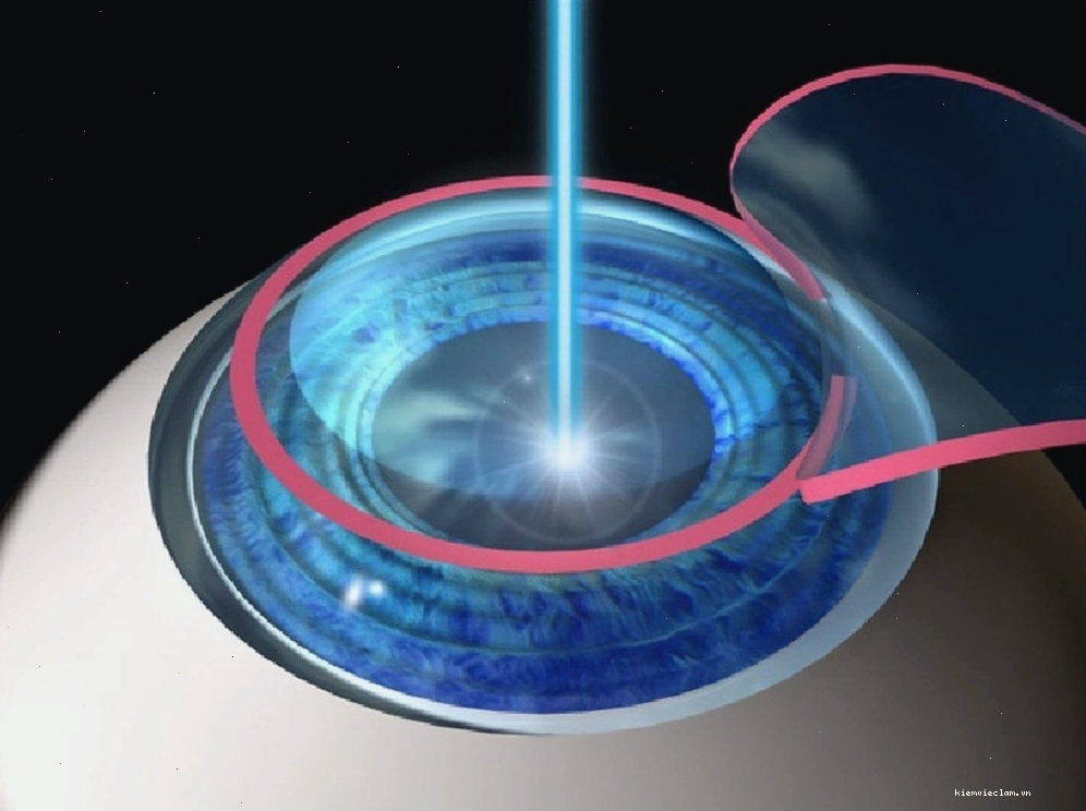 Hình ảnh minh họa quá trình phẫu thuật Lasik để điều trị tật khúc xạ
