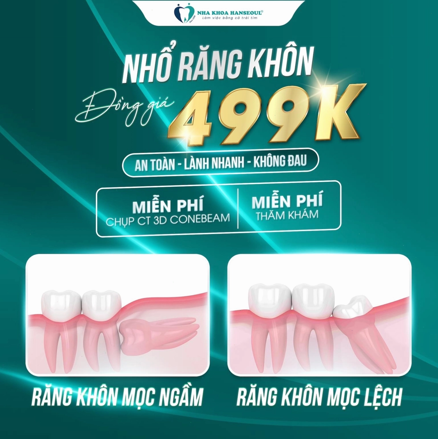 Hình ảnh minh họa quá trình trám răng