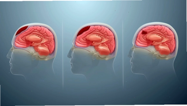 Hình ảnh minh họa subdural hematoma