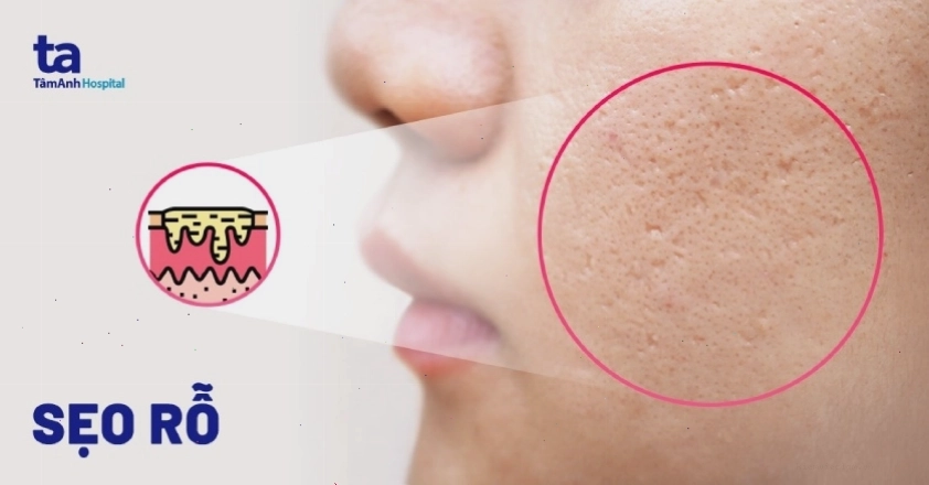 Hình ảnh minh họa tình trạng sẹo rỗ trên da mặt