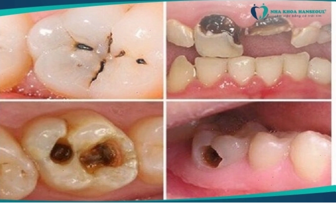 Hình ảnh minh họa về sâu răng, không phải con sâu răng thực tế