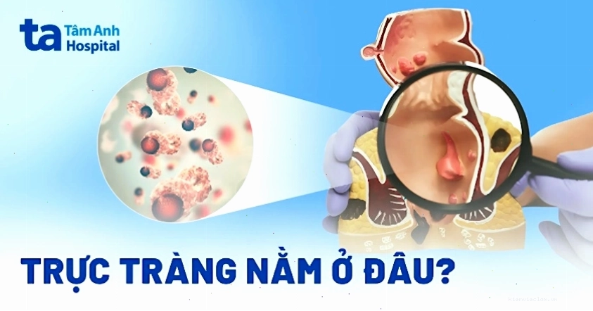 Hình ảnh minh họa vị trí trực tràng trong cơ thể