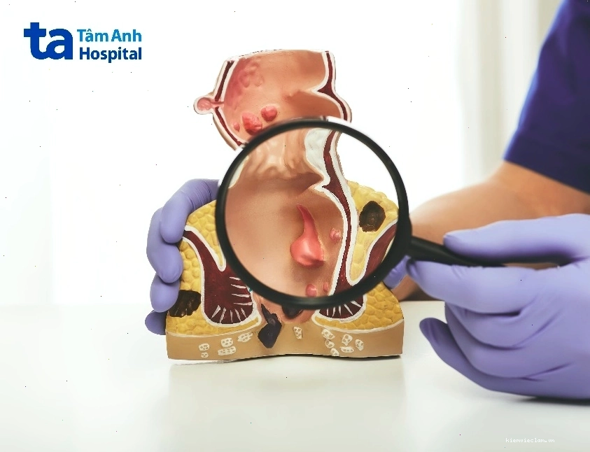 Hình ảnh mô phỏng bệnh trĩ nội ở trực tràng