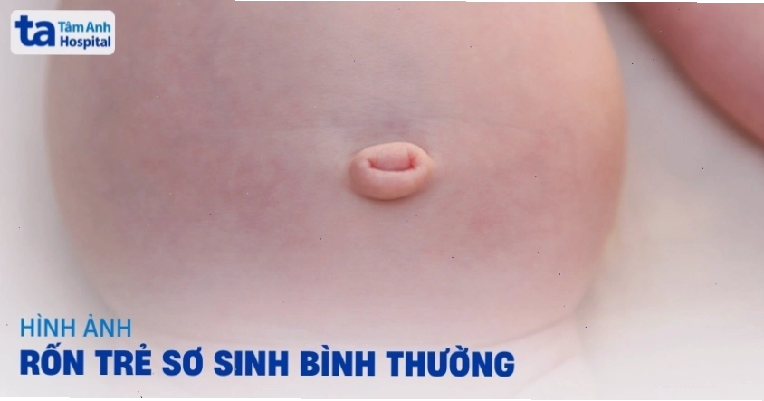 Hình ảnh rốn trẻ sơ sinh bình thường với cuống rốn còn nguyên vẹn